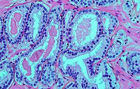 #thelancetoncology #cancerdelaprostate #scoredegleason Approches de l’apprentissage en profondeur pour l’évaluation des biopsies de la prostate par le score de Gleason