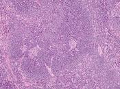 #thelancethaematology #maladiedecastleman #siltuximab Innocuité long terme siltuximab chez patients atteints maladie Castleman multicentrique idiopathique analyse d’étude d’extension prévue l’avance deux essais ouverts