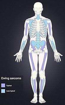 #thelancetoncology #cabozantinib #ostéosarcome #sarcomedewing Cabozantinib chez des patients atteints d’un sarcome d’Ewing ou d’osteosarcome (CABONE) : essai de phase 2 multicentrique à simple bras