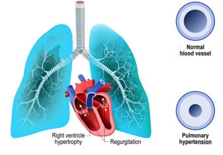 Des bactéries intestinales spécifiques peuvent être associées à une hypertension artérielle pulmonaire