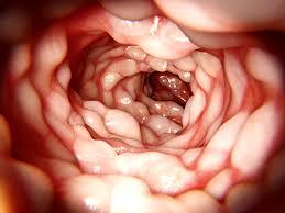 Maladie de Crohn : les causes