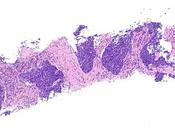 #thelancetoncology #cancerdupoumon #atezolizumab Atezolizumab néoadjuvant chimiothérapie chez patients atteints cancer poumon petites cellules essai ouvert multicentrique phase simple bras