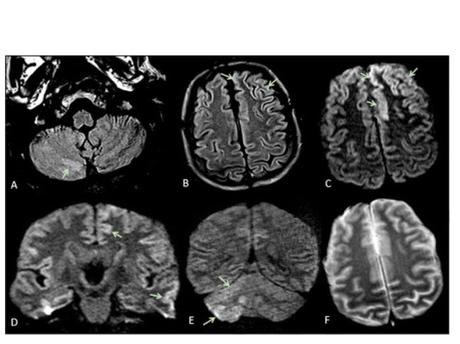 L'étude montre que ces complications neurologiques peuvent inclure plusieurs types d’encéphalopathie dont le syndrome d'encéphalopathie réversible postérieure (avec anomalies radiologiques cérébrales bilatérales réversibles- voir visuel ci-contre), l'encéphalopathie hypoxique ischémique ou encore une exacerbation de la maladie démyélinisante. L'étude montre que ces complications neurologiques peuvent inclure plusieurs types d’encéphalopathie dont le syndrome d'encéphalopathie réversible postérieure (avec anomalies radiologiques cérébrales bilatérales réversibles- voir visuel ci-contre), l'encéphalopathie hypoxique ischémique ou encore une exacerbation de la maladie démyélinisante.