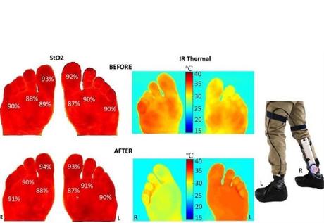 Bien que les pieds des participants diabétiques soient devenus plus chauds que ceux des volontaires sains pendant la marche sur tapis roulant, leur température moyenne n’a pas dépassé 27,5 degrés C