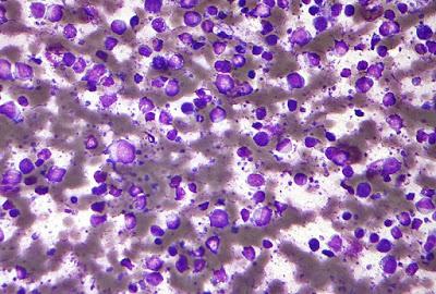 Lymphome diffus à grandes cellules B - Source: Wikipedia