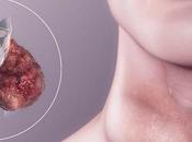 hypothyroïdie symptômes Causes, Traitement