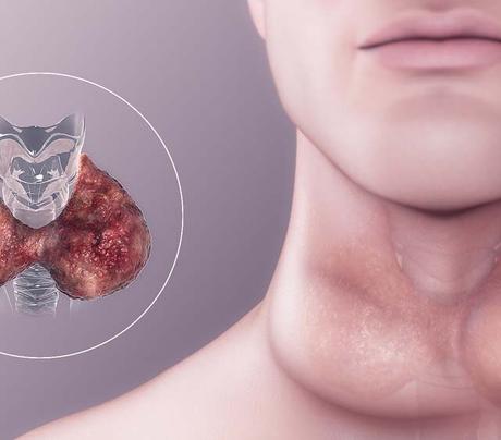 hypothyroïdie symptômes Causes, Traitement Hypothyroïdie