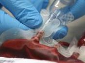 #thelancethaematology #COVID-19 #transfusionsanguine Effet pandémie COVID-19 l’approvisionnement sang utilisation pour transfusions