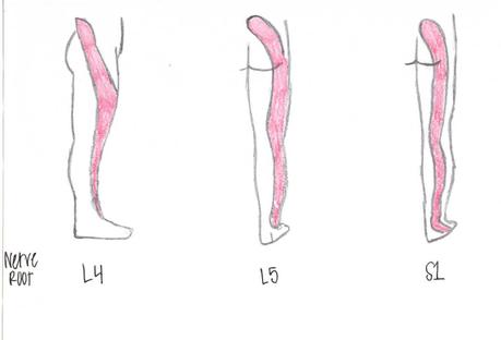 Neuropathie diabétique: types, symptômes, prévention, traitement 14 neuropathie diabétique