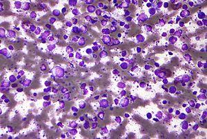 #thelancet #lymphome #lymphomeàgrandescellulesB Lisocabtagene maraleucel pour des patients atteints de lymphomes à grandes cellules B (TRANSCEND NHL 001) : étude multicentrique de conception homogène