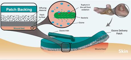 Ce pansement « gazeux » est appliqué sur la plaie, puis connecté à un petit appareil générateur d'ozone alimenté par batterie. L'ozone gazeux est diffusé de manière hyper-ciblée à la surface de la peau sur le site de la plaie (Visuel Université Purdue / Rahim Rahimi)