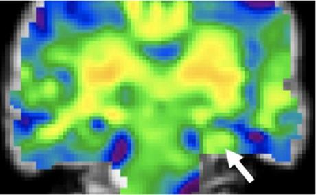 L'élastographie par résonance magnétique (ERM) en permettant une comparaison précoce de la rigidité de l'hippocampe chez des patients épileptiques vs en bonne santé, permet d’améliorer la détection et la caractérisation de la maladie (Visuel Beckman Institute).