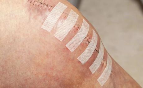 Suturer une plaie : méthodes et délai de retrait des points de suture