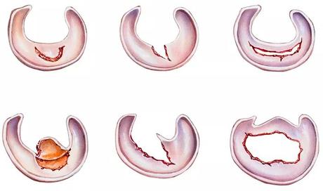 Blocages du genou : Causes et traitements