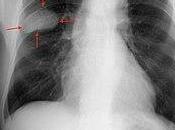 #thelancetoncology #exclusif #CBNPC #biomarqueurs Biomarqueurs comme indicateurs traitements chez patients préalablement traités pour cancer petites cellules squameux (Lung-MAP SWOG S1400) protocole leader d’essai clinique guidé b...