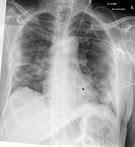 Covid-19 Infection des poumons