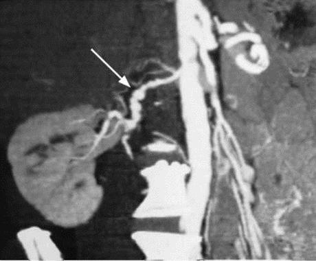 Hypertension nephrogene Hypertension nephrogene