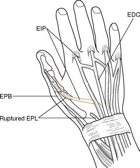 Link Download cpt code repair extensor pollicis longus Kindle Edition PDF