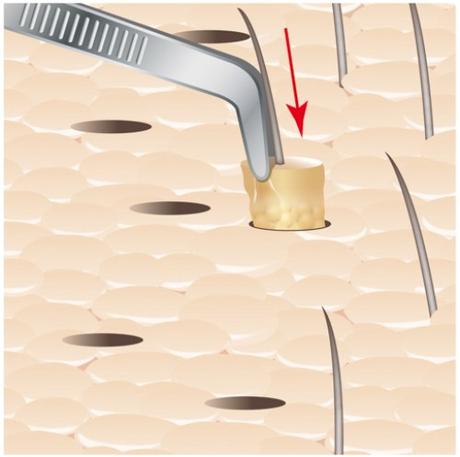 ESTE MEDICA – clinique de chirurgie capillaire