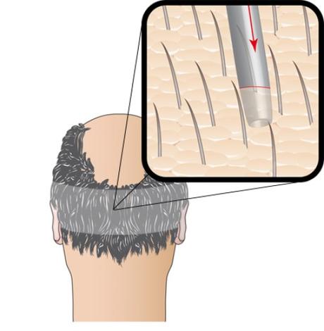 ESTE MEDICA – clinique de chirurgie capillaire