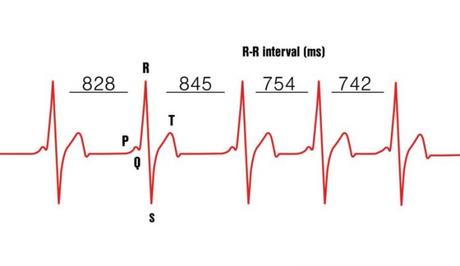 Variabilité de fréquence cardiaque