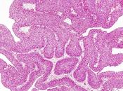 CANCER VESSIE L’efficacité conjugués anticorps-médicaments