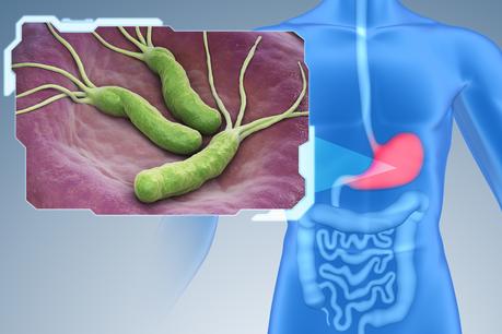 Chez certaines personnes, les infections à H. pylori augmentent le risque de cancer gastrique, ainsi que d'autres maladies telles que les ulcères gastroduodénaux et la gastrite (Visuel Fotolia)