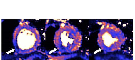 Parmi les lésions cardiaques documentées, la restriction de l'apport sanguin au cœur (ischémie) (Visuel European Heart Journal) Parmi les lésions cardiaques documentées, la restriction de l'apport sanguin au cœur (ischémie) (Visuel European Heart Journal)