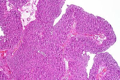 #thelancetoncology #carcinomeurothélial #atezolizumab Atezolizumab en adjuvant versus observation dans le cas du carcinome urothélial invasif sur le plan musculaire (IMvigor010) : essai multicentrique de phase 3 randomisé en ouvert