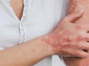 PSORIASIS Mais pourquoi risque cardiovasculaire