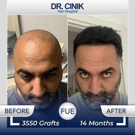 Docteur Cinik : Expert reconnu de la greffe de cheveux en Turquie