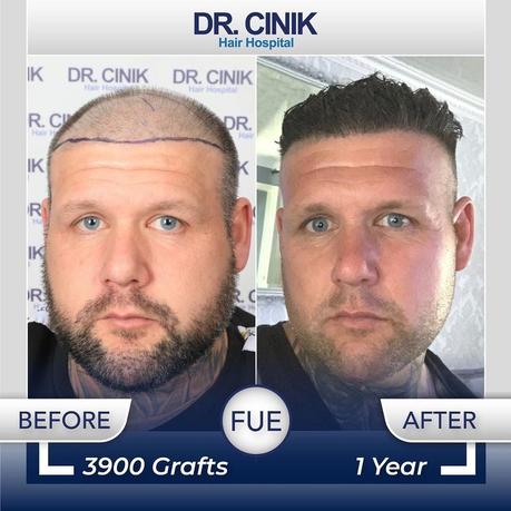 Docteur Cinik : Expert reconnu de la greffe de cheveux en Turquie