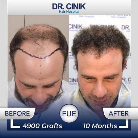 Docteur Cinik : Expert reconnu de la greffe de cheveux en Turquie
