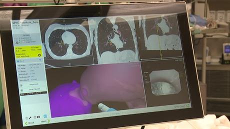 La nouvelle technologie de type GPS du Trumbull Regional Medical Center aide à détecter le cancer du poumon Système de navigation thoracique SPiN au centre médical régional Trumbull