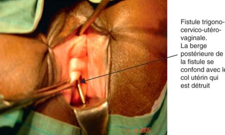 Chirurgie réparatrice : Au moins 500 femmes pourraient en bénéficier d’ici la fin d’année au Cameroun