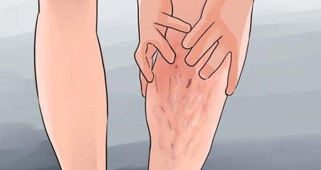 Conseils pour soulager la douleur des varices Os