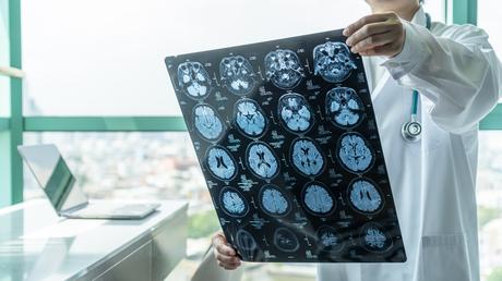 50 millions de personnes dans le monde sont atteintes de différentes formes de démences, dont la maladie d’Alzheimer, et cette prévalence pourrait atteindre 152 millions de cas en 2050 (Visuel Adobe Stock 296940799) 50 millions de personnes dans le monde sont atteintes de différentes formes de démences, dont la maladie d’Alzheimer, et cette prévalence pourrait atteindre 152 millions de cas en 2050 (Visuel Adobe Stock 296940799)