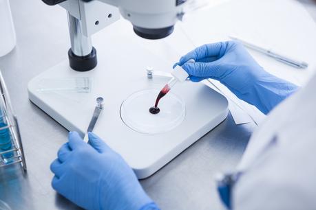 Ce test sanguin permet d'identifier la maladie résiduelle après l'intervention chirurgicale, le risque de récidive du cancer de la vessie, et de guider le clinicien vers un traitement de précision (Visuel Adobe Stock 114589392). Ce test sanguin permet d'identifier la maladie résiduelle après l'intervention chirurgicale, le risque de récidive du cancer de la vessie, et de guider le clinicien vers un traitement de précision (Visuel Adobe Stock 114589392).