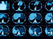 CANCER UROTHÉLIAL AVANCÉ nouvelle option prometteuse