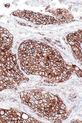 #thelancet #cancerdupoumon #atezolizumab Atezolizumab adjuvant après chimiothérapie adjuvante dans le cancer du poumon non à petites cellules réséqué de stade IB-IIIA (IMpower010) : un essai de phase 3 randomisé, multicentrique, en ouvert