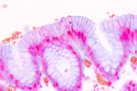 Une mutation génétique affaiblit les propriétés de barrière des cellules épithéliales qui tapissent l'intestin et favorise la perméabilité ou fuite intestinale (Visuel Fotolia)