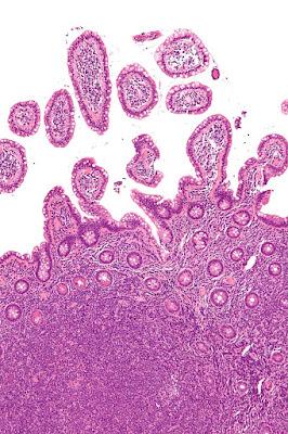 #thelancetoncology #axibabtageneciloleucel #lymphomenonhodgkinien Axicabtagene ciloleucel dans le lymphome non hodgkinien indolent en rechute ou réfractaire (ZUMA-5) : un essai de phase 2 multicentrique à un seul bras
