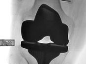 ARTHROSE GENOU promesses l’ablation radiofréquence