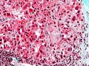 #thelancetoncology #carciniomehépatocellulaire #nivolumab #sorafenib Nivolumab versus sorafenib dans carcinome hépatocellulaire avancé (CheckMate 459) essai phase randomisé, multicentrique, ouvert