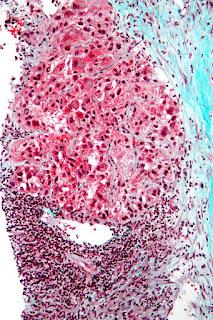 #thelancetoncology #carciniomehépatocellulaire #nivolumab #sorafenib Nivolumab versus sorafenib dans le carcinome hépatocellulaire avancé (CheckMate 459) : un essai de phase 3 randomisé, multicentrique, en ouvert