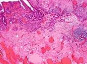 #thelancetoncology #adénocarcinomedeloeusophage #trastuzumab Trastuzumab avec traitement trimodal l'adénocarcinome l'œsophage surexpression HER2 (NRG Oncology/RTOG 1010) essai multicentrique, randomisé, phase