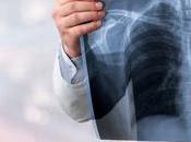 CANCER POUMON nouvelles cibles thérapeutiques prometteuses