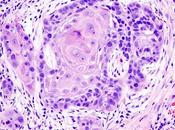 #thelancetgastroenterologyandhepatology #pembrolizumab #carcinomeépidermoïdeanal Pembrolizumab pour carcinome épidermoïde anal avancé préalablement traité résultats l'étude randomisée, multicohorte, multicentrique, phase KEYNOTE-158