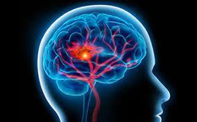 Fortes inégalités sociales face au risque de survenue d’un accident vasculaire cérébral