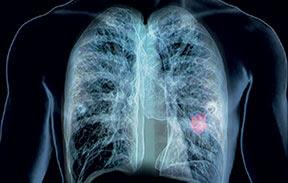 #thelancetrespiratorymedicine #cancerdupoumon #dépistage Faisabilité du dépistage du cancer du poumon dans les régions défavorisées